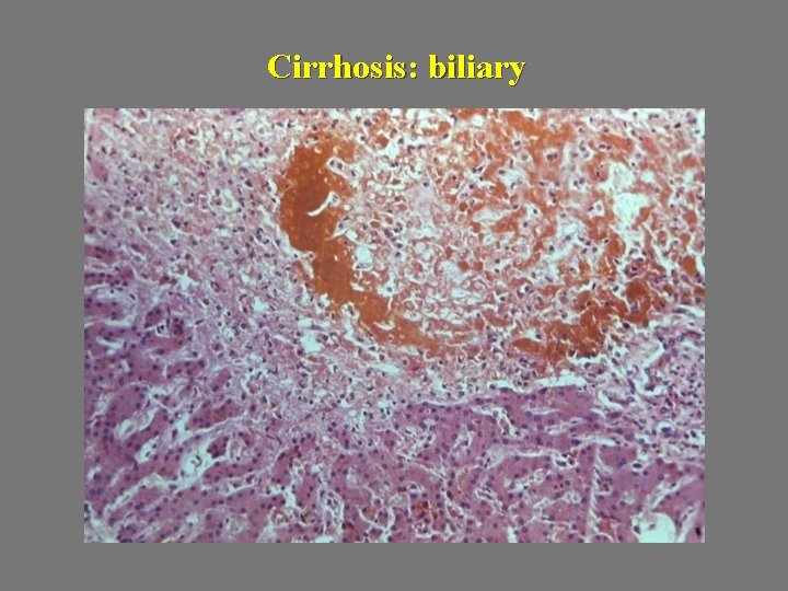 Cirrhosis: biliary 
