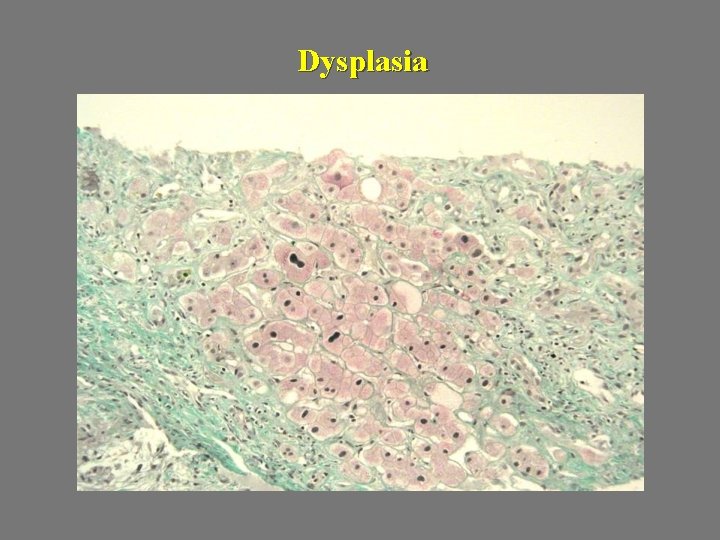 Dysplasia 