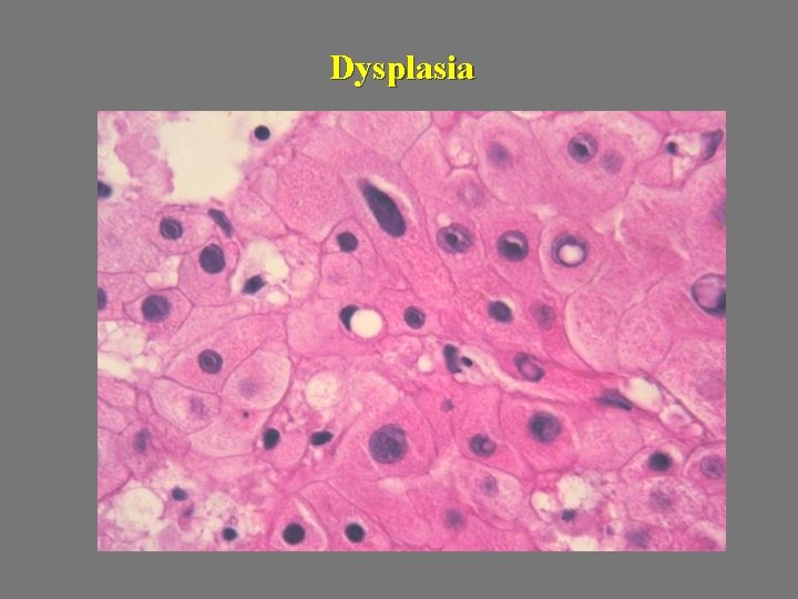 Dysplasia 