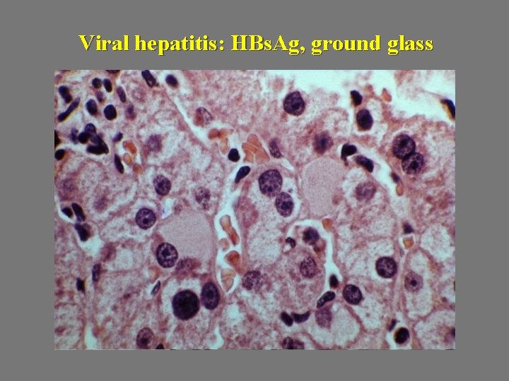 Viral hepatitis: HBs. Ag, ground glass 