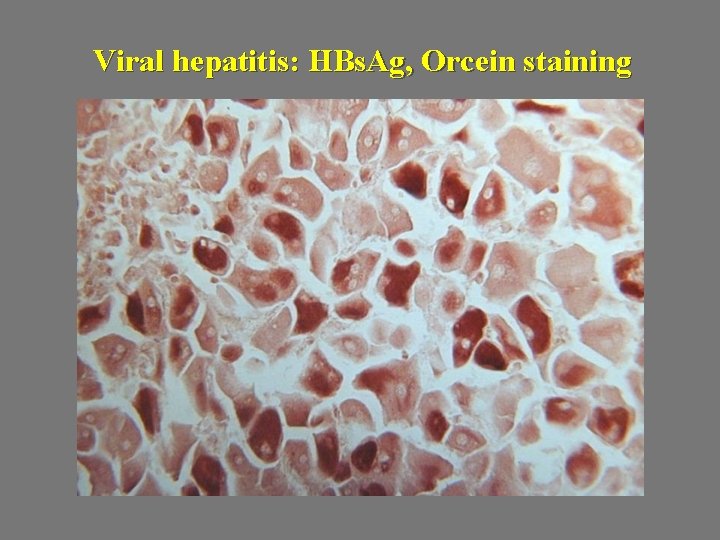 Viral hepatitis: HBs. Ag, Orcein staining 