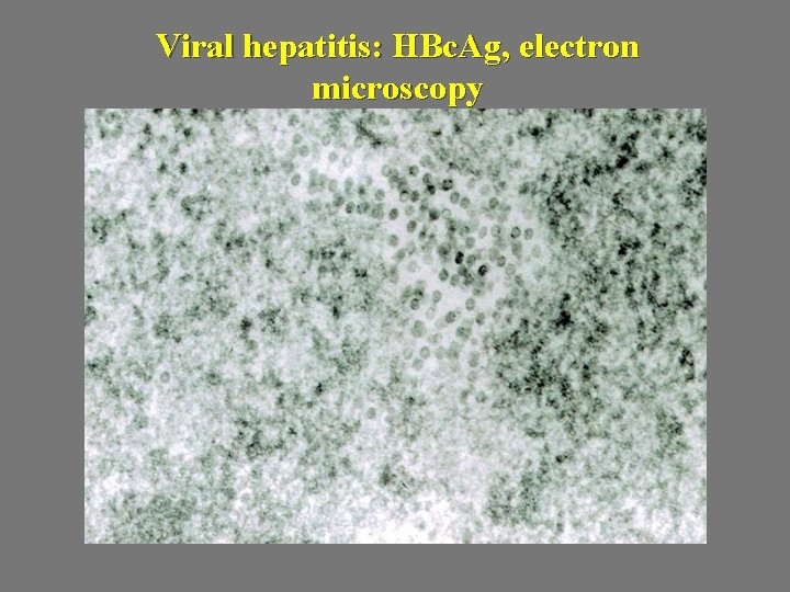 Viral hepatitis: HBc. Ag, electron microscopy 