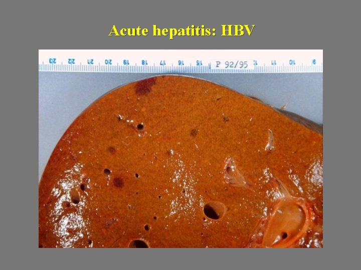 Acute hepatitis: HBV 