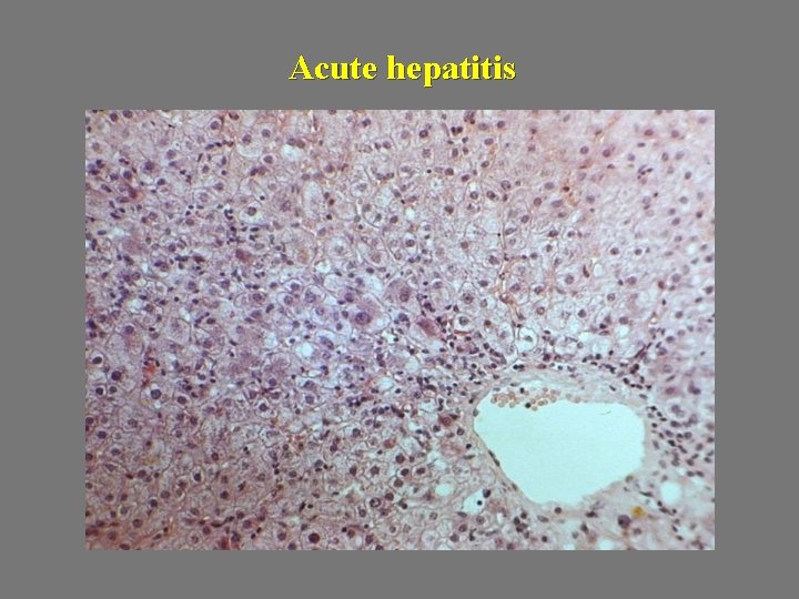 Acute hepatitis 