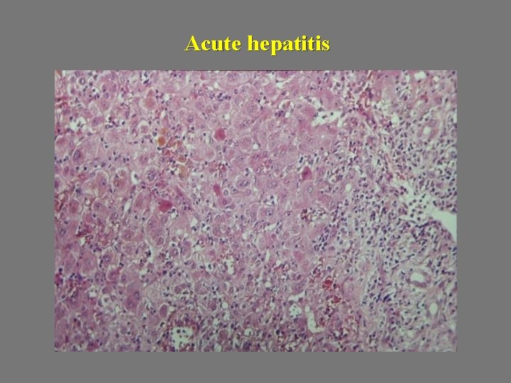 Acute hepatitis 