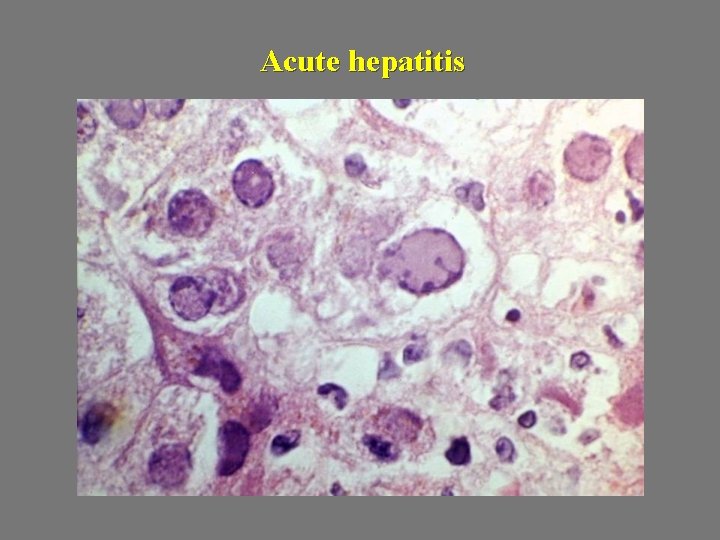 Acute hepatitis 