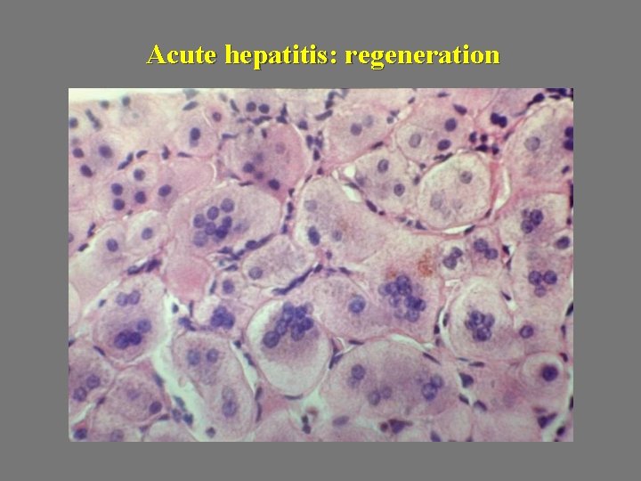 Acute hepatitis: regeneration 