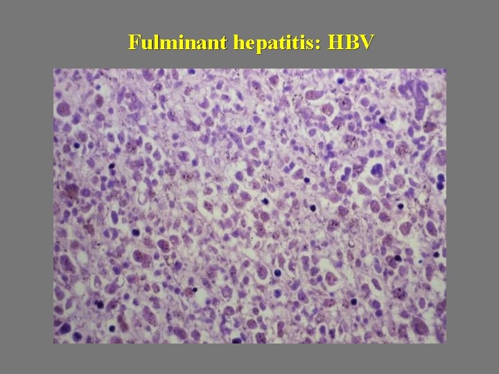 Fulminant hepatitis: HBV 