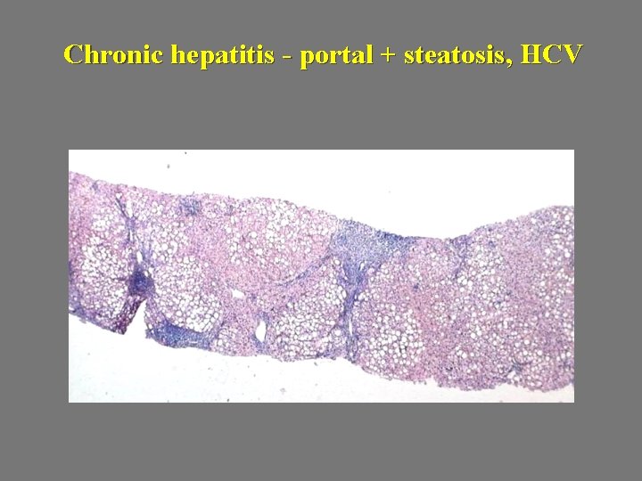 Chronic hepatitis - portal + steatosis, HCV 