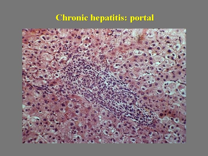 Chronic hepatitis: portal 