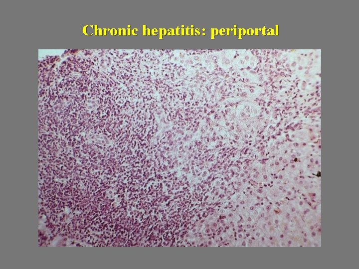 Chronic hepatitis: periportal 