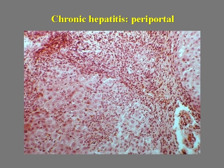 Chronic hepatitis: periportal 