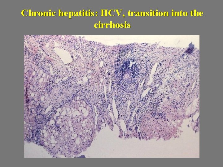 Chronic hepatitis: HCV, transition into the cirrhosis 