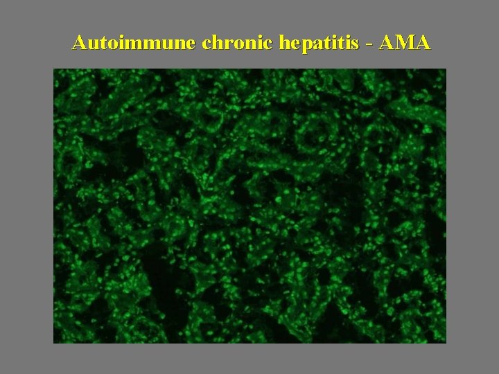 Autoimmune chronic hepatitis - AMA 