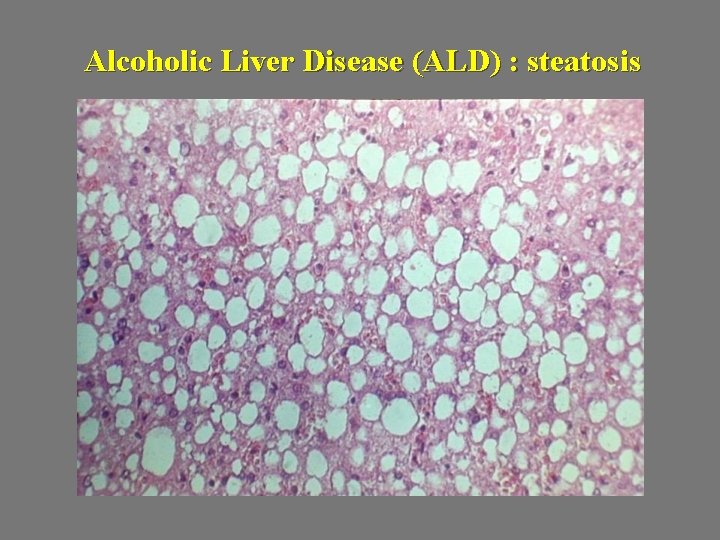 Alcoholic Liver Disease (ALD) : steatosis 