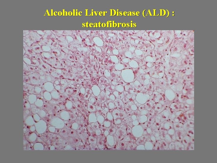 Alcoholic Liver Disease (ALD) : steatofibrosis 