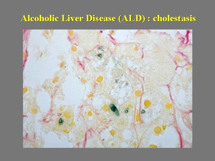 Alcoholic Liver Disease (ALD) : cholestasis 