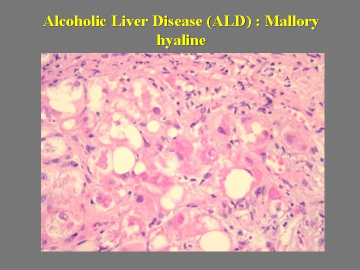 Alcoholic Liver Disease (ALD) : Mallory hyaline 