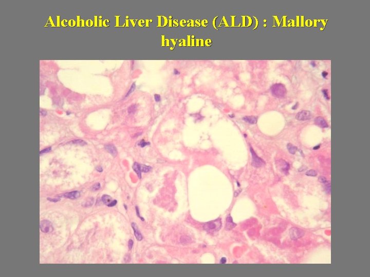 Alcoholic Liver Disease (ALD) : Mallory hyaline 