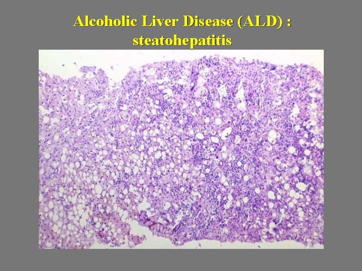 Alcoholic Liver Disease (ALD) : steatohepatitis 