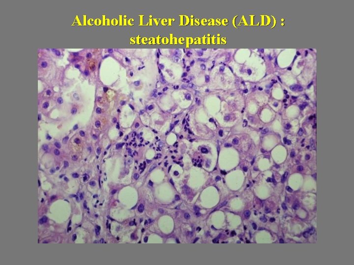 Alcoholic Liver Disease (ALD) : steatohepatitis 