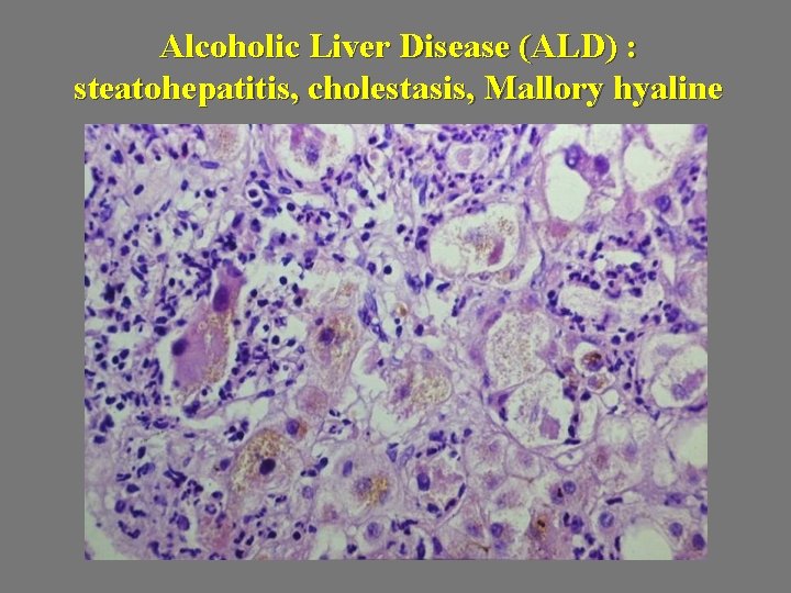 Alcoholic Liver Disease (ALD) : steatohepatitis, cholestasis, Mallory hyaline 
