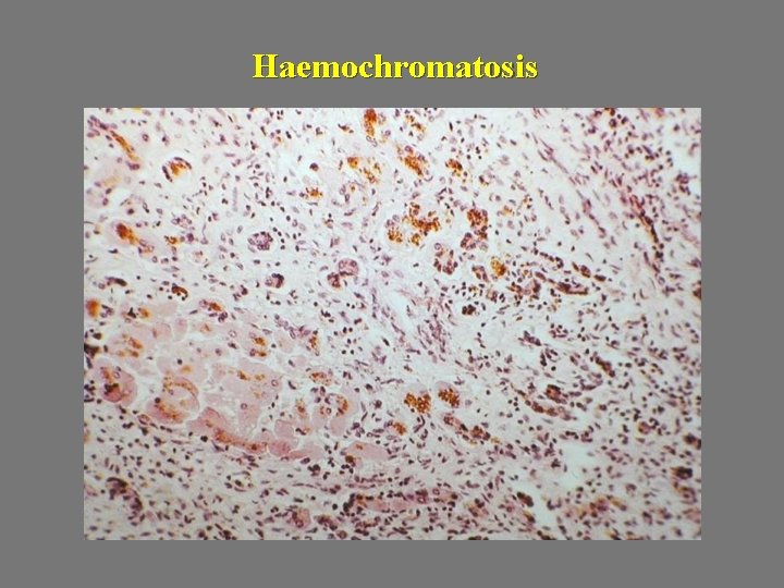 Haemochromatosis 