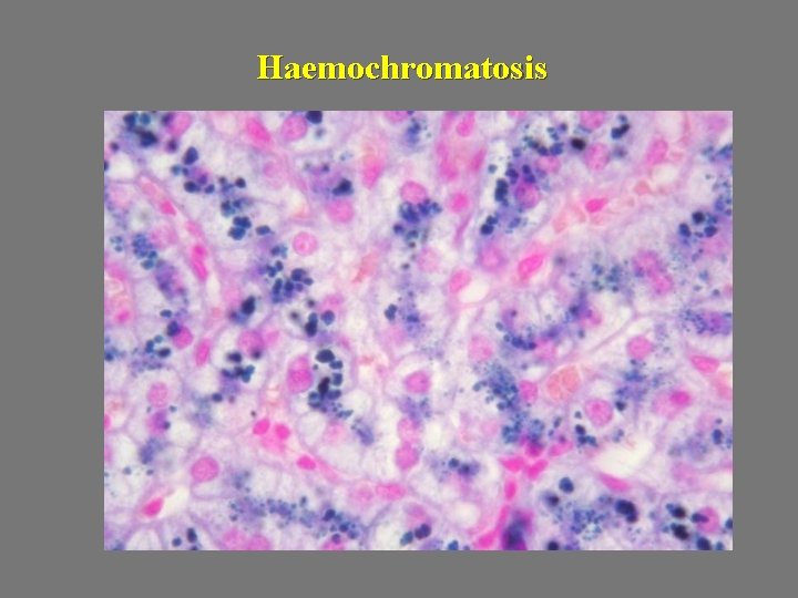 Haemochromatosis 