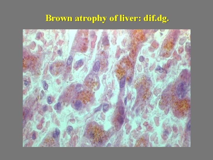 Brown atrophy of liver: dif. dg. 
