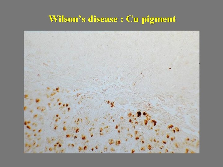 Wilson’s disease : Cu pigment 