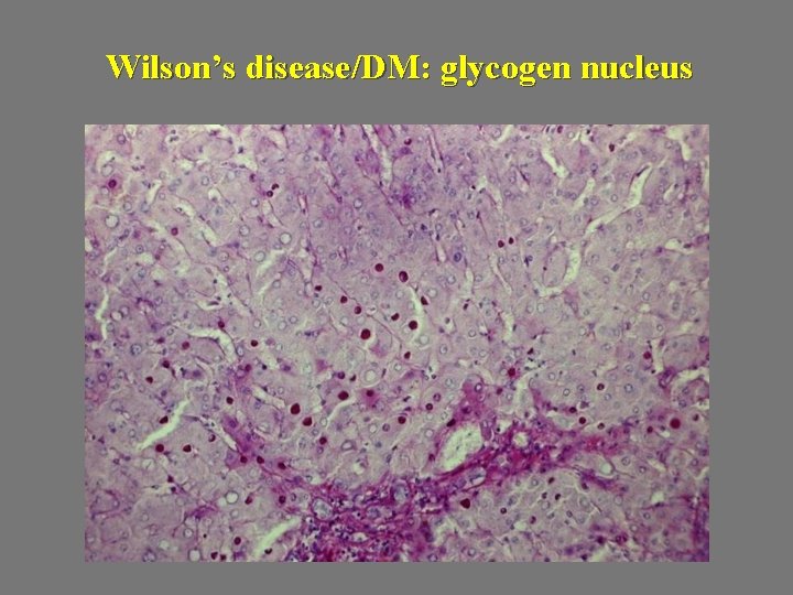 Wilson’s disease/DM: glycogen nucleus 