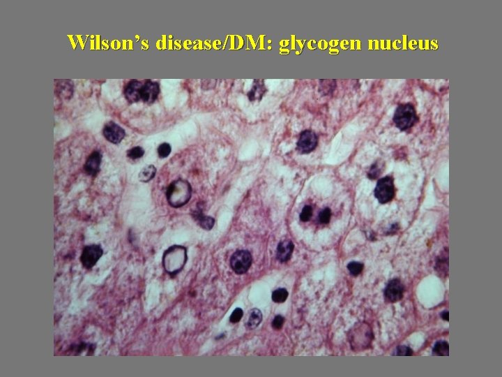 Wilson’s disease/DM: glycogen nucleus 