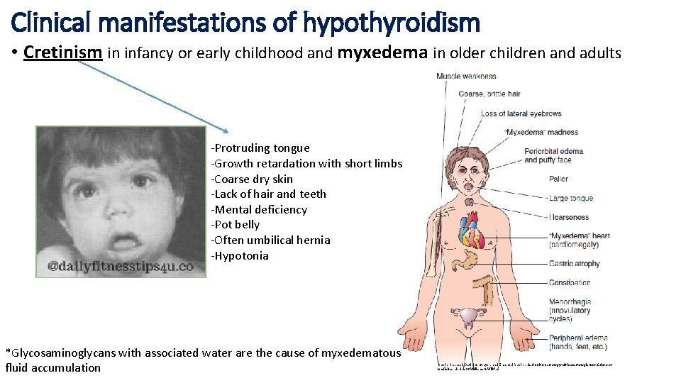 Clinical manifestations of hypothyroidism • Cretinism in infancy or early childhood and myxedema in