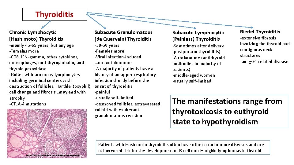 Thyroiditis Chronic Lymphocytic (Hashimoto) Thyroiditis -mainly 45 -65 years, but any age -Females more