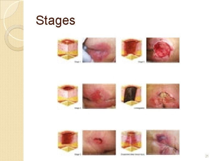 Stages 21 