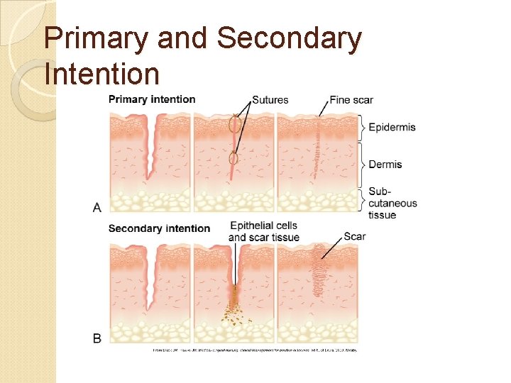 Primary and Secondary Intention 
