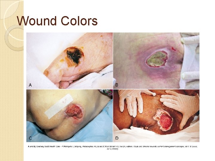 Wound Colors 