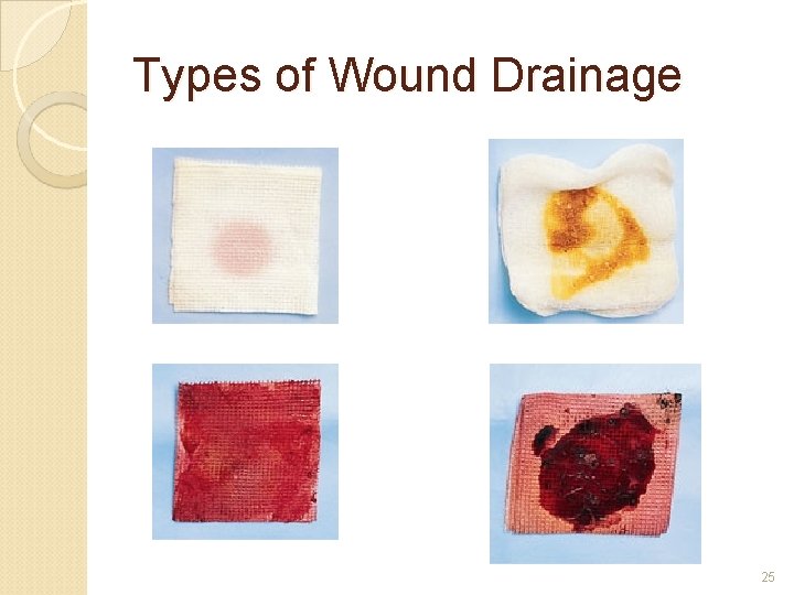 Types of Wound Drainage 25 