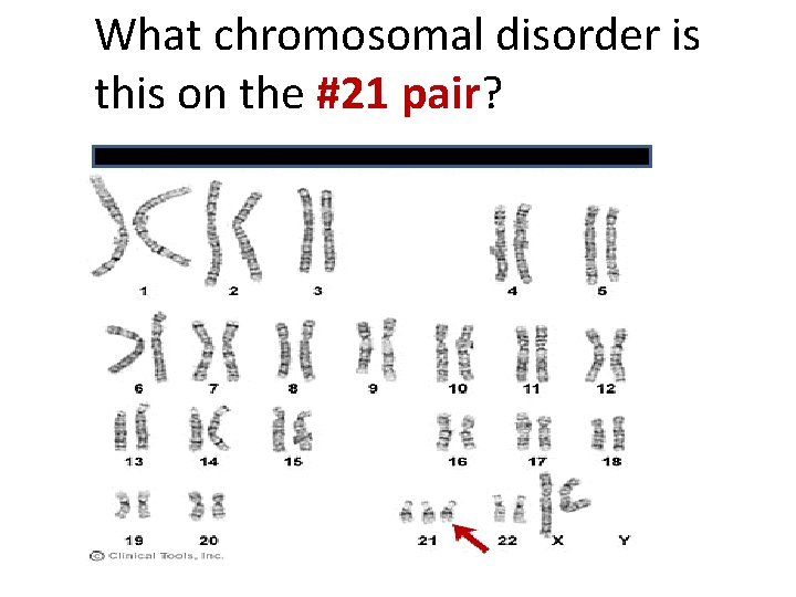 What chromosomal disorder is this on the #21 pair? 