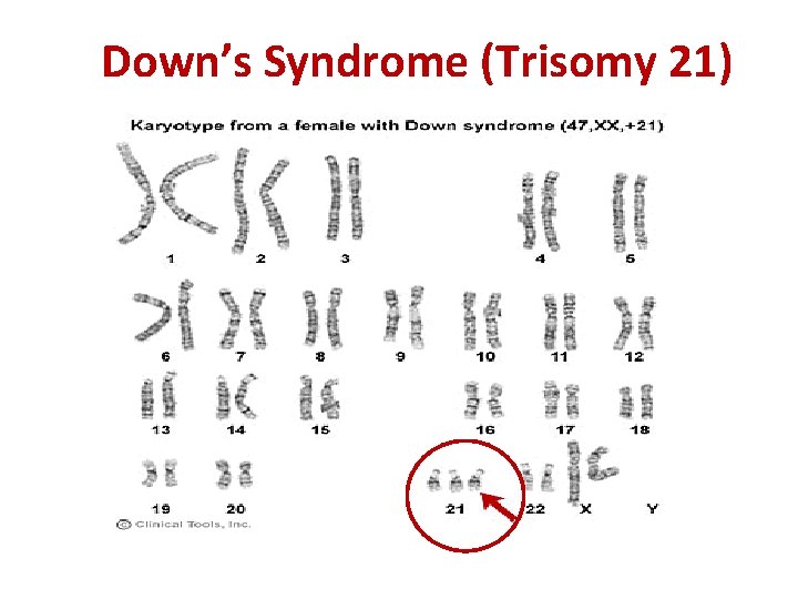 Down’s Syndrome (Trisomy 21) 