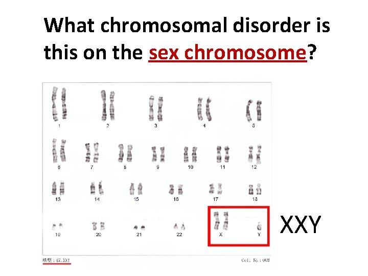 What chromosomal disorder is this on the sex chromosome? XXY 