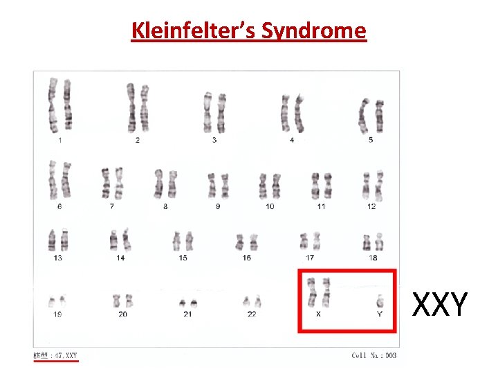 Kleinfelter’s Syndrome XXY 