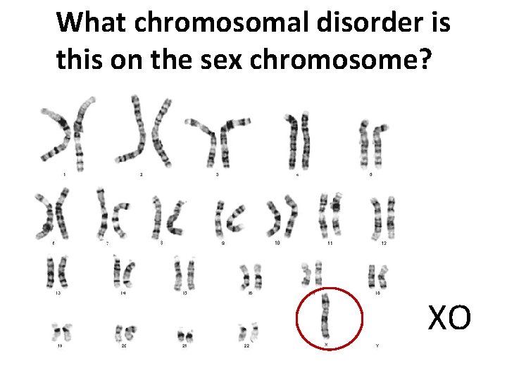 What chromosomal disorder is this on the sex chromosome? XO 