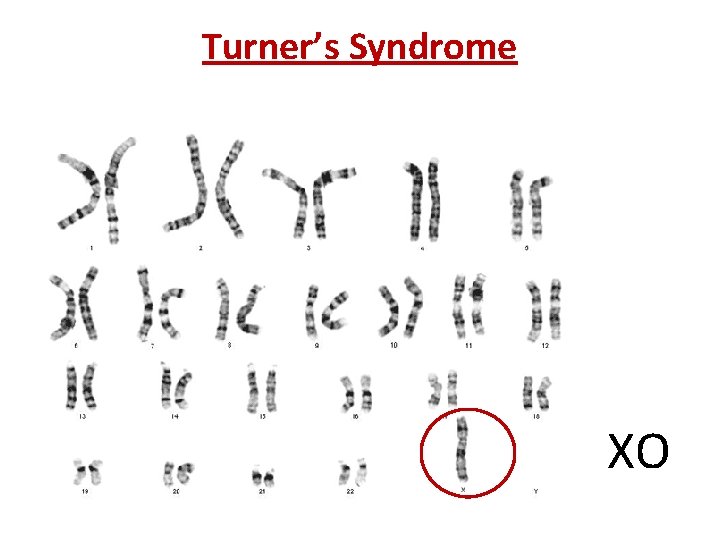 Turner’s Syndrome XO 
