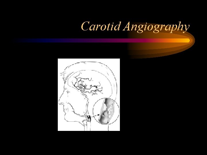 Carotid Angiography 