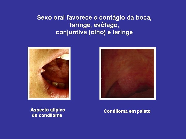 Sexo oral favorece o contágio da boca, faringe, esôfago, conjuntiva (olho) e laringe Aspecto