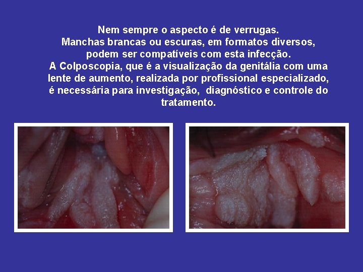 Nem sempre o aspecto é de verrugas. Manchas brancas ou escuras, em formatos diversos,