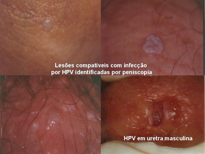 Lesões compatíveis com infecção por HPV identificadas por peniscopia HPV em uretra masculina 