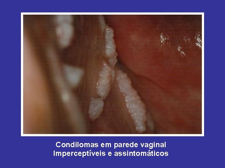 Condilomas em parede vaginal Imperceptíveis e assintomáticos 