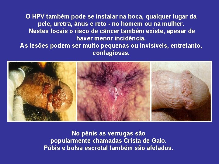 O HPV também pode se instalar na boca, qualquer lugar da pele, uretra, ânus